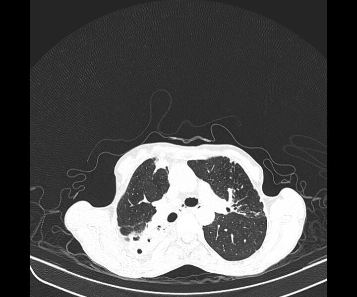 File:Aspergillomas (Radiopaedia 66779-76110 Axial lung window 20).jpg