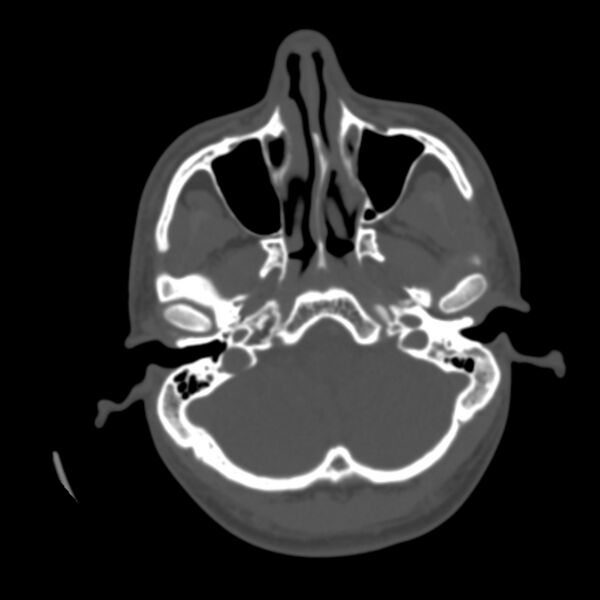 File:Asymptomatic occipital spur (Radiopaedia 87753-104201 Axial bone window 23).jpg