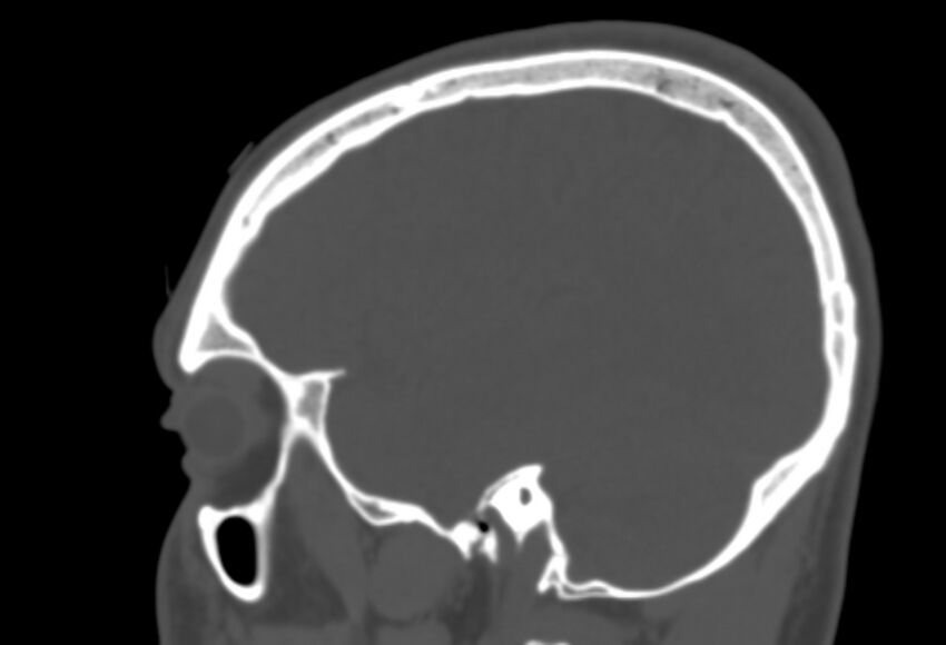 Asymptomatic occipital spur (Radiopaedia 87753-104201 Sagittal bone window 233).jpg