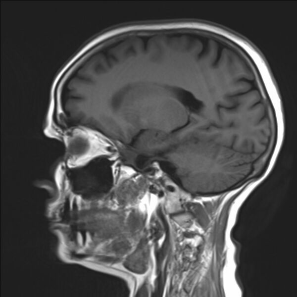 File:Atlanto-occipital assimilation with basilar invagination (Radiopaedia 70122-80157 Sagittal T1 15).jpg