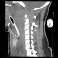 Atlanto-occipital dislocation (Radiopaedia 44648-48412 A 17).jpg
