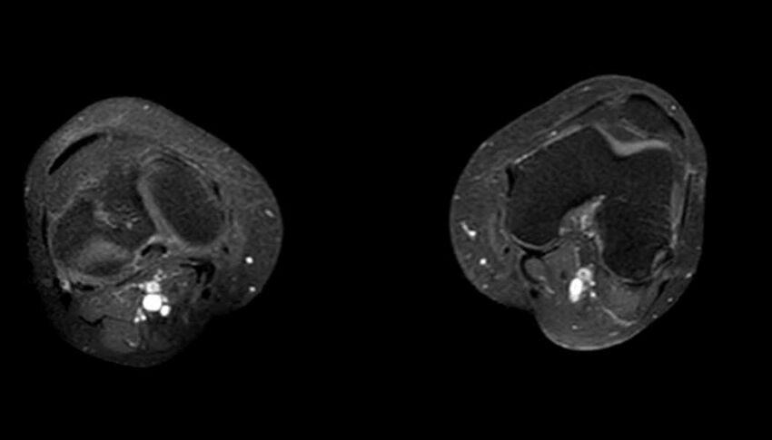 Atypical lipomatous tumor - thigh (Radiopaedia 68975-78734 Axial T1 C+ fat sat 7).jpg