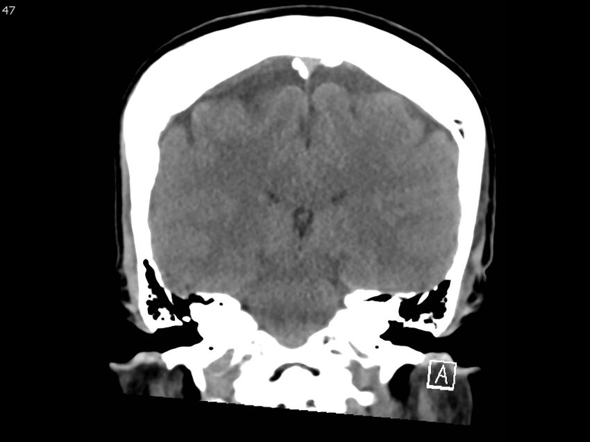 Atypical meningioma - intraosseous (Radiopaedia 64915-73867 B 46).jpg