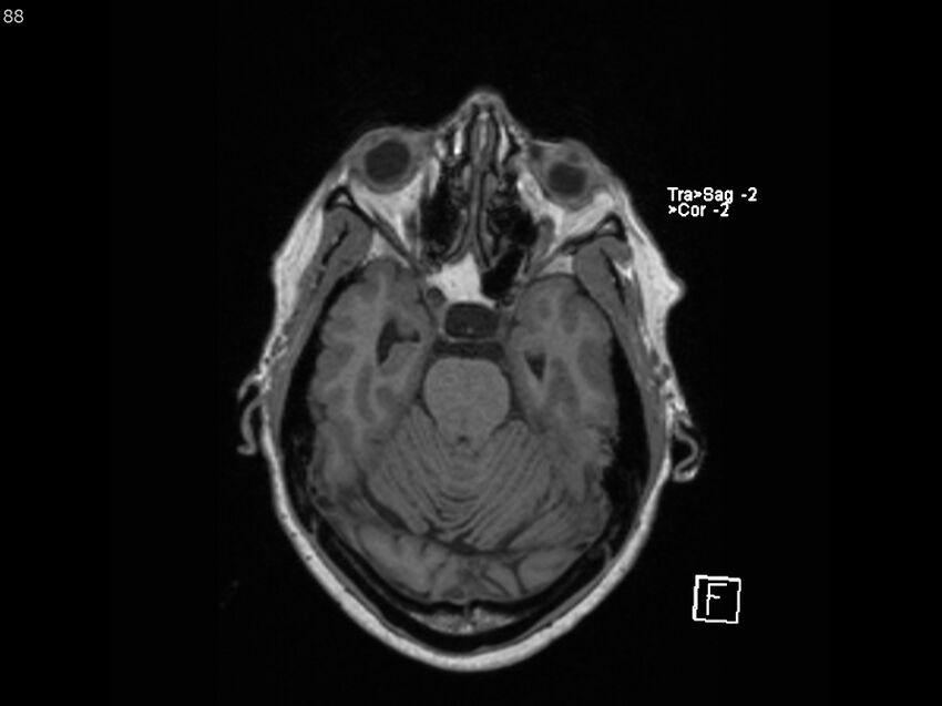 Atypical meningioma - intraosseous (Radiopaedia 64915-74572 Axial T1 88).jpg