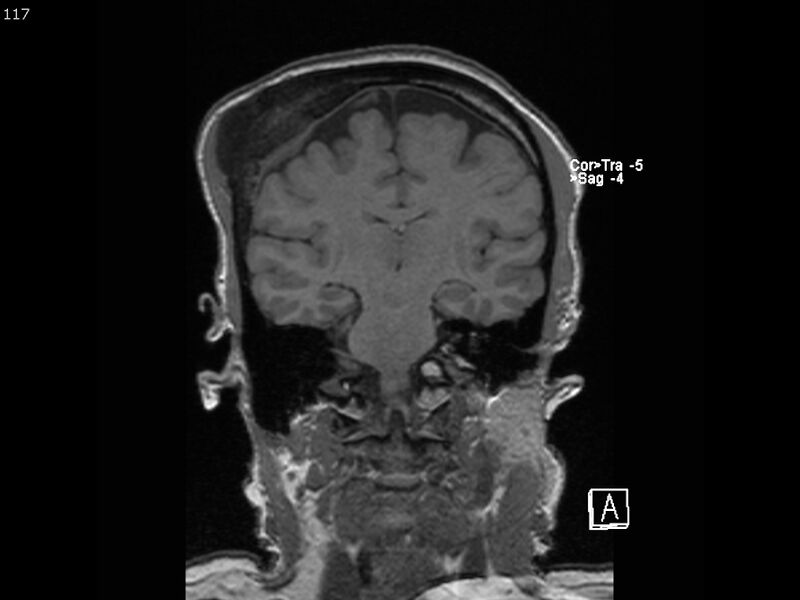 File:Atypical meningioma - intraosseous (Radiopaedia 64915-74572 Coronal T1 117).jpg