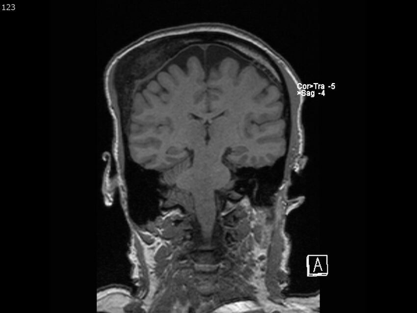 Atypical meningioma - intraosseous (Radiopaedia 64915-74572 Coronal T1 123).jpg