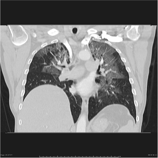 File:Atypical pneumonia - Q fever (Radiopaedia 21993-21989 C 22).jpg