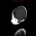 Atypical teratoid rhabdoid tumor (Radiopaedia 10712-11183 Sagittal T1 2).jpg