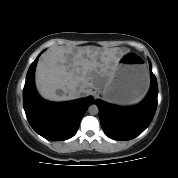 File:Autosomal dominant polycystic kidney disease (Radiopaedia 23061-23093 Axial non-contrast 8).jpg