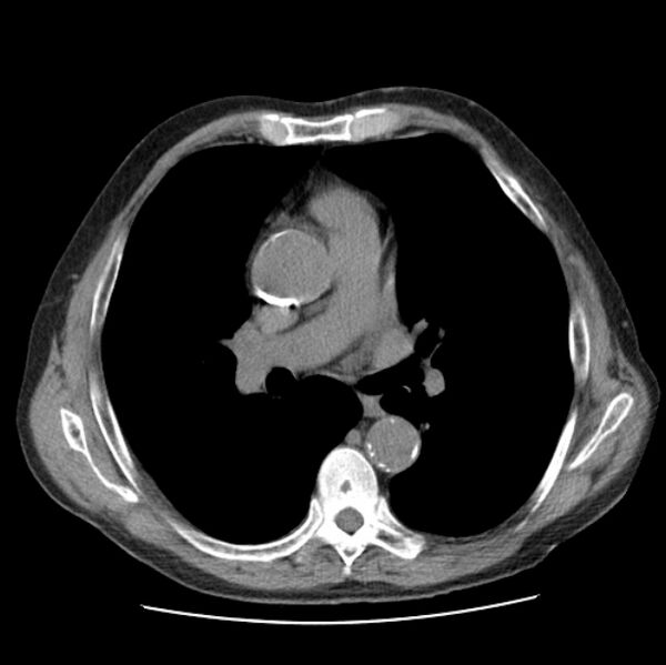 File:Autosomal dominant polycystic kidney disease (Radiopaedia 27851-28094 Axial non-contrast 27).jpg