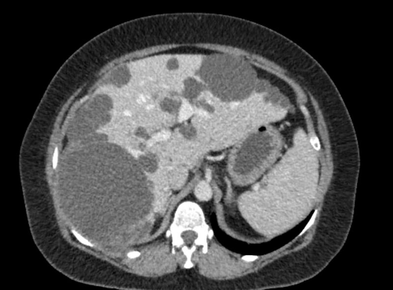 File:Autosomal dominant polycystic kidney disease (Radiopaedia 57124-64017 A 35).jpg