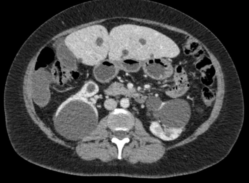 File:Autosomal dominant polycystic kidney disease (Radiopaedia 57124-64017 A 55).jpg