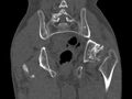 Avascular necrosis of the left hip (Radiopaedia 75068-86125 Coronal bone window 68).jpg