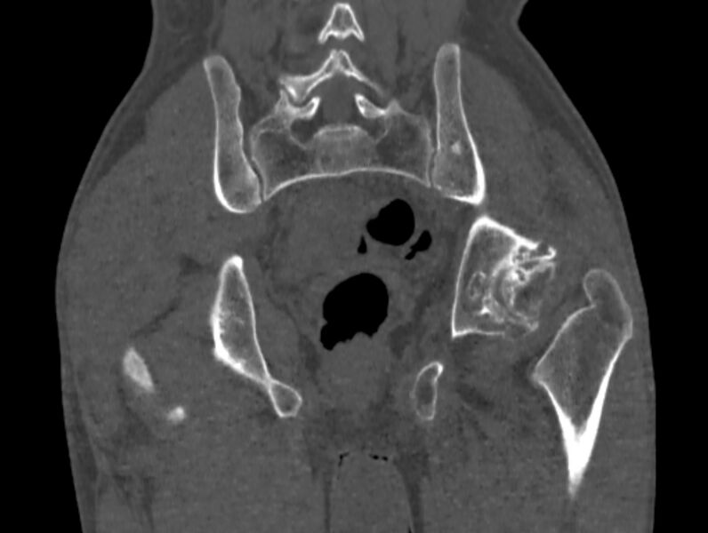 File:Avascular necrosis of the left hip (Radiopaedia 75068-86125 Coronal bone window 68).jpg