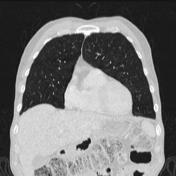 File:Azygos lobe (Radiopaedia 38259-40275 Coronal lung window 22).jpg