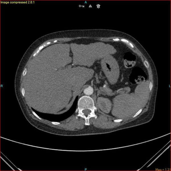 File:Azygos vein aneurysm (Radiopaedia 77824-90130 B 52).jpg