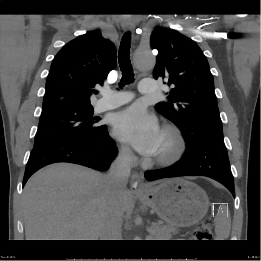 Azygos venous system anatomy (CT pulmonary angiography) (Radiopaedia 25928-26077 Coronal C+ CTPA 39).jpg