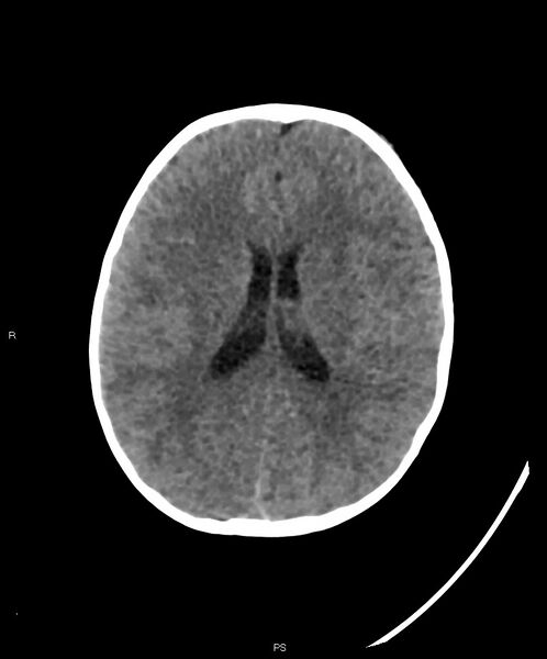 File:Basal ganglia and parenchymal ischemia (Radiopaedia 45818-50083 Axial non-contrast 18).jpg