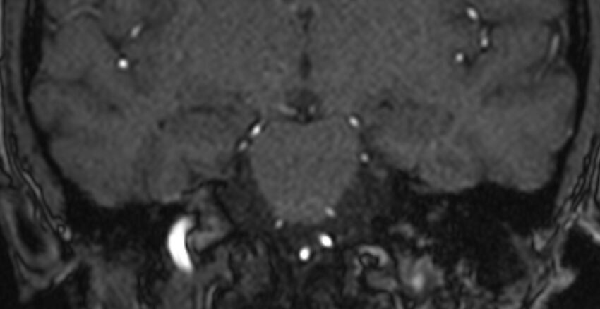 Basilar artery fenestration (Radiopaedia 74537-85455 Coronal MRA TOF 53).jpg