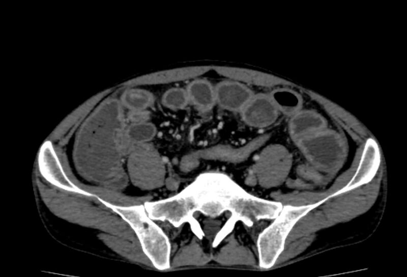 File:Behçet's disease- abdominal vasculitis (Radiopaedia 55955-62570 A 64).jpg