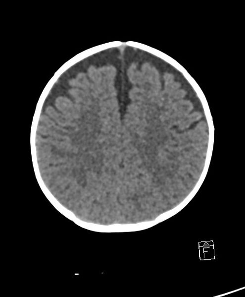 File:Benign enlargement of subarachnoid spaces in infancy (BESS) (Radiopaedia 87459-103795 Axial non-contrast 28).jpg