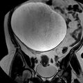 Benign seromucinous cystadenoma of the ovary (Radiopaedia 71065-81300 F 12).jpg