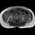 Bicornuate uterus (Radiopaedia 61974-70046 Axial T1 3).jpg