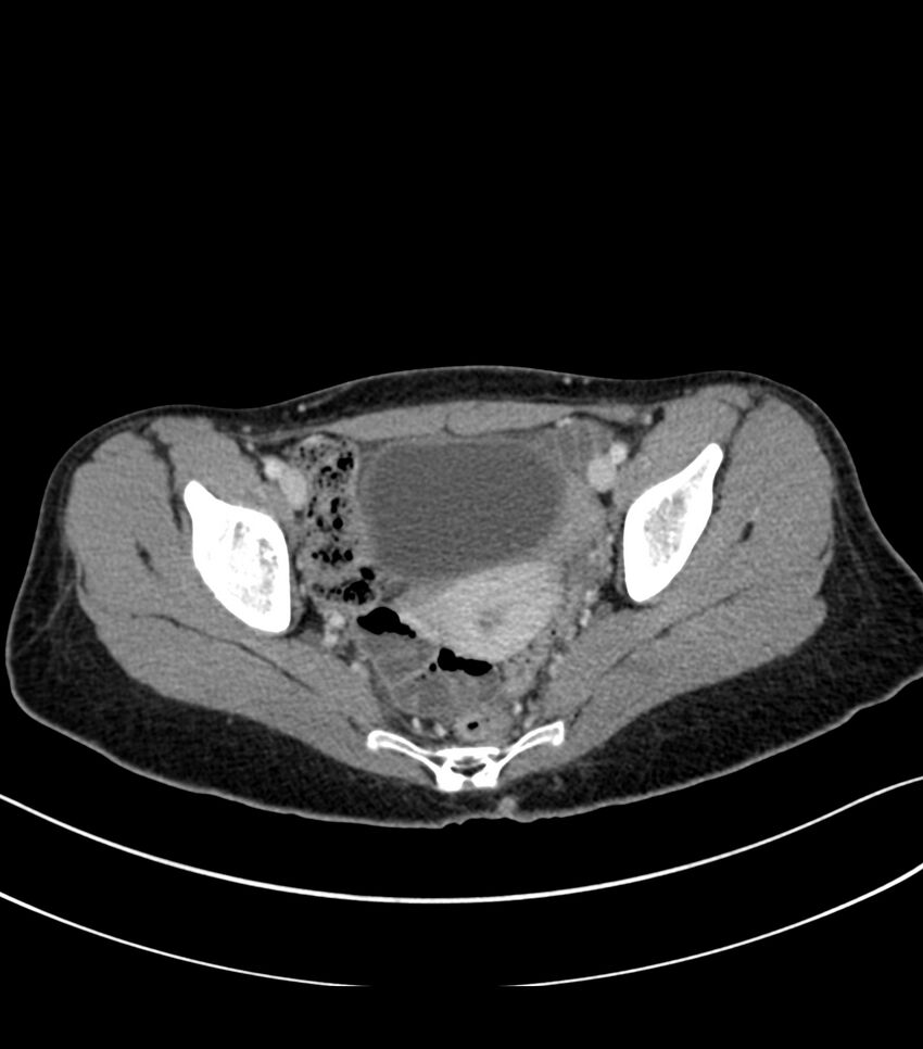 Bilateral kidney malrotation (Radiopaedia 72227-82749 A 60).jpg