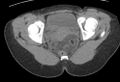 Bilateral mature cystic ovarian teratoma (Radiopaedia 88821-105592 Axial non-contrast 41).jpg