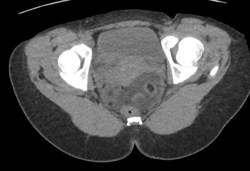 File:Bilateral mature cystic ovarian teratoma (Radiopaedia 88821-105592 Axial non-contrast 41).jpg