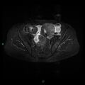 Bilateral ovarian fibroma (Radiopaedia 44568-48293 Axial STIR 10).jpg