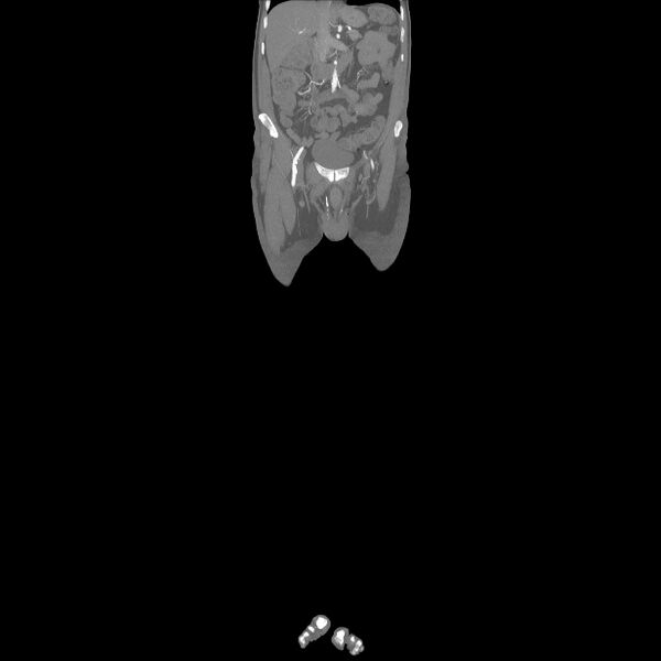 File:Bilateral superficial femoral arterial occlusion (Radiopaedia 25682-25857 Coronal MIP 10).jpg