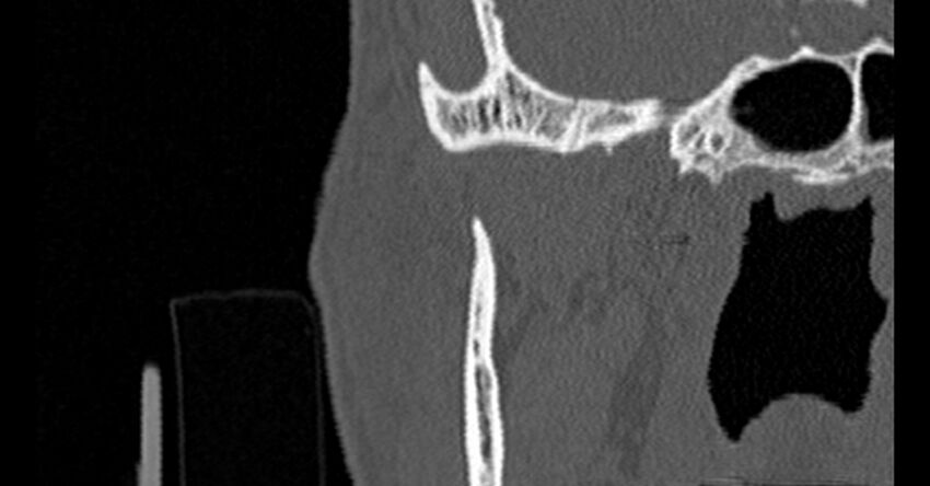 Bilateral temporal bone fractures (Radiopaedia 29482-29970 Coronal non-contrast 9).jpg
