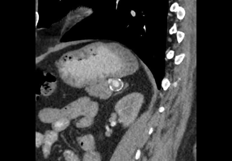 File:Bilateral urolithiasis with incidentally detected splenic artery aneurysm and left inferior vena cava (Radiopaedia 44467-48127 Ob. Sag. C+ Art. 25).jpg