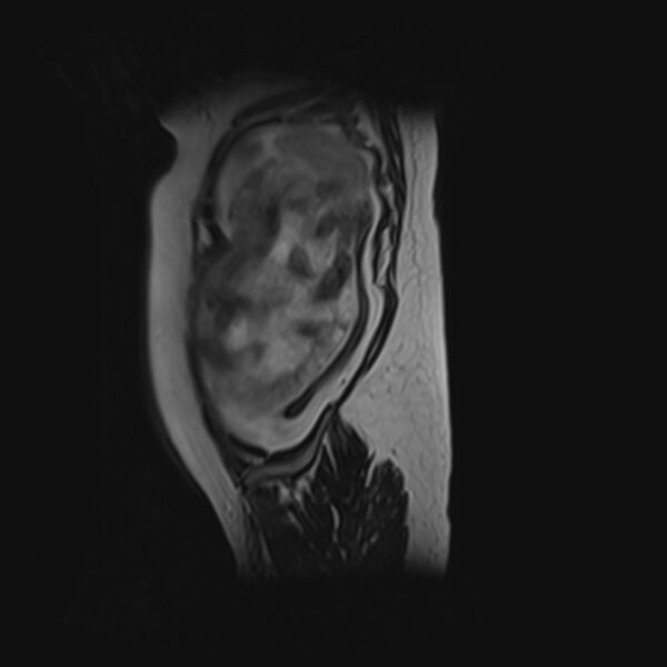 File:Bilobed placenta accreta (Radiopaedia 69648-79591 G 1).jpg