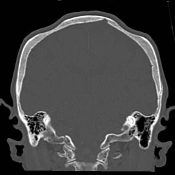 File:Biparietal osteodystrophy (Radiopaedia 46109-50463 Coronal bone window 66).jpg