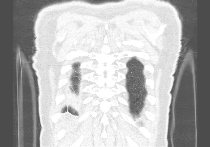File:Birt-Hogg-Dubé syndrome (Radiopaedia 52578-58491 Coronal lung window 60).jpg