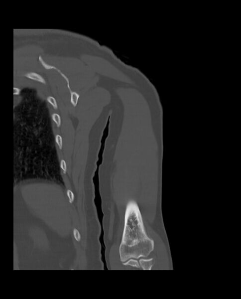 File:Bizarre parosteal osteochondromatous proliferation (Radiopaedia 84221-99501 Coronal bone window 25).jpg