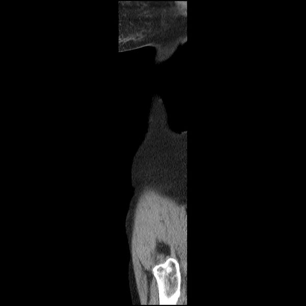 File:Bladder tumor detected on trauma CT (Radiopaedia 51809-57609 E 73).jpg