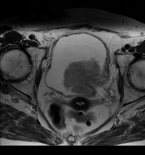 File:Bladder tumor detected on trauma CT (Radiopaedia 51809-57639 Axial T2 8).jpg