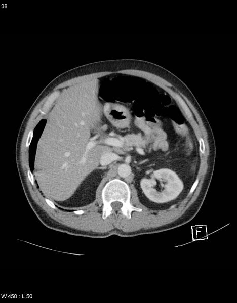 File:Boerhaave syndrome with tension pneumothorax (Radiopaedia 56794-63603 A 19).jpg