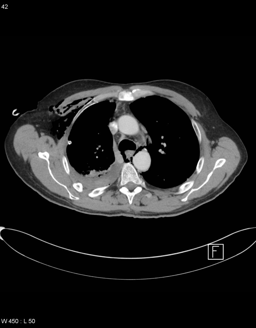 Boerhaave syndrome with tension pneumothorax (Radiopaedia 56794-63605 A 20).jpg
