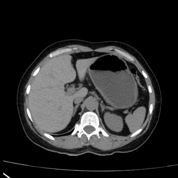 File:Bosniak renal cyst - type I (Radiopaedia 27479-27675 Axial non-contrast 21).jpg
