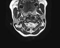 Brachial plexus birth palsy (Radiopaedia 68118-77604 Axial T2 1).jpg