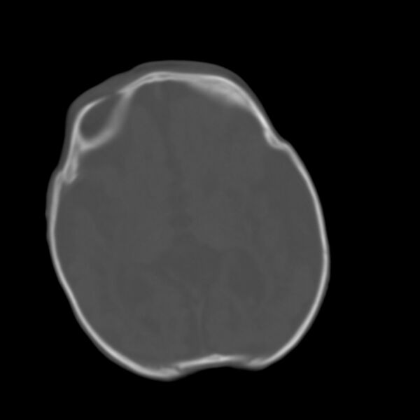 File:Brachycephaly (bi-coronal and bi-lambdoid synostosis) (Radiopaedia 55048-61413 Axial bone window 8).jpg
