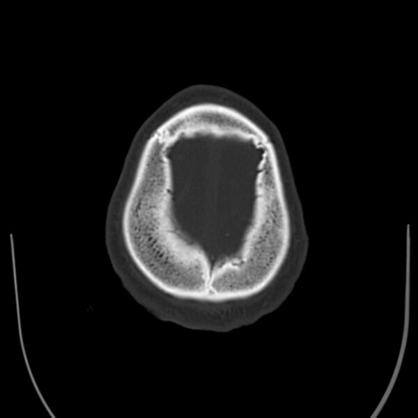 File:Brain Pantopaque remnants (Radiopaedia 78403-91048 Axial bone window 62).jpg