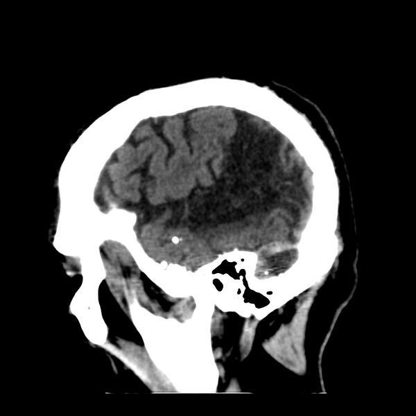 File:Brain Pantopaque remnants (Radiopaedia 78403-91048 C 11).jpg