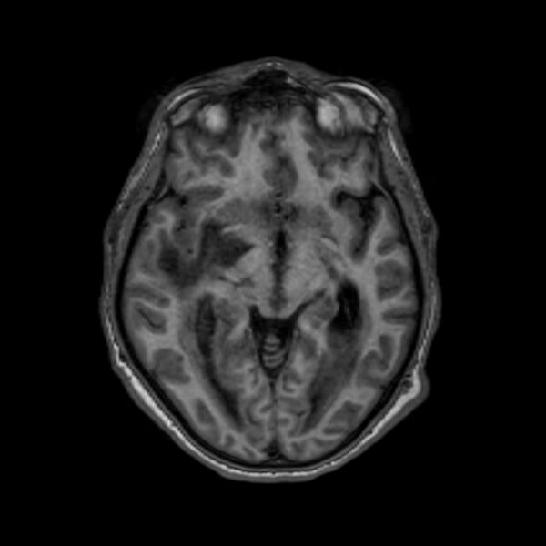 File:Brain abscess complicated by intraventricular rupture and ventriculitis (Radiopaedia 82434-96577 Axial T1 29).jpg