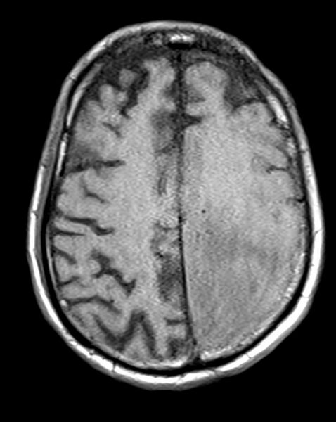 File:Brain abscess with dual rim sign (Radiopaedia 87566-103938 Axial T1 18).jpg