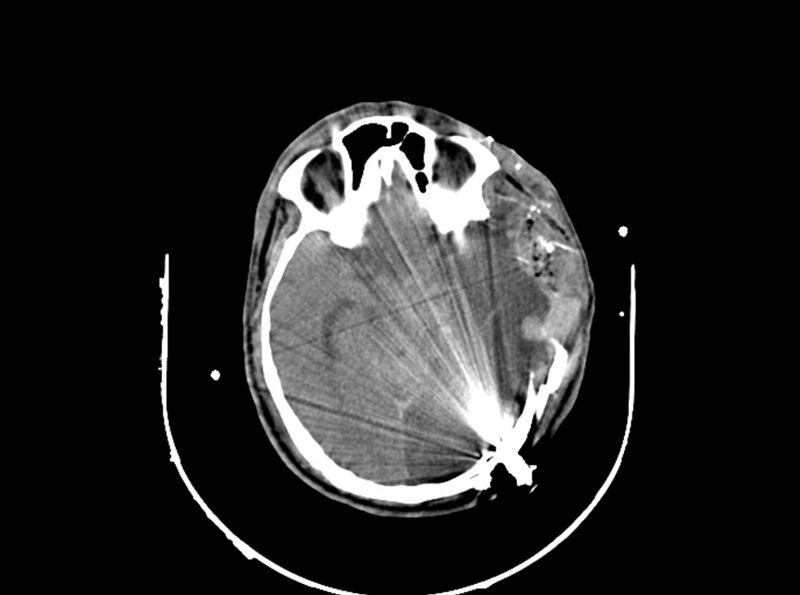 File:Brain injury by firearm projectile (Radiopaedia 82068-96087 B 92).jpg